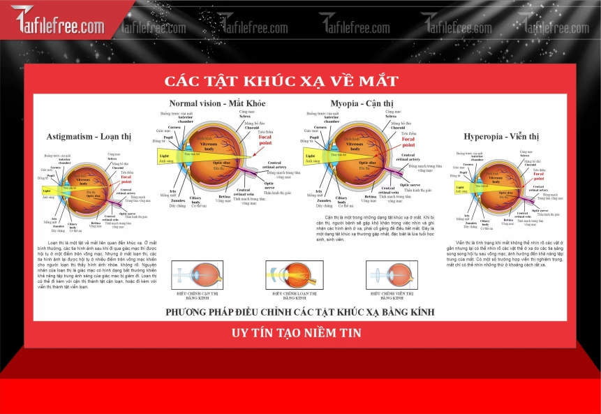Mẫu Sơ đồ/Áp Phích Thông Tin Về Các Tật Khúc Xạ Của Mắt_BH1113